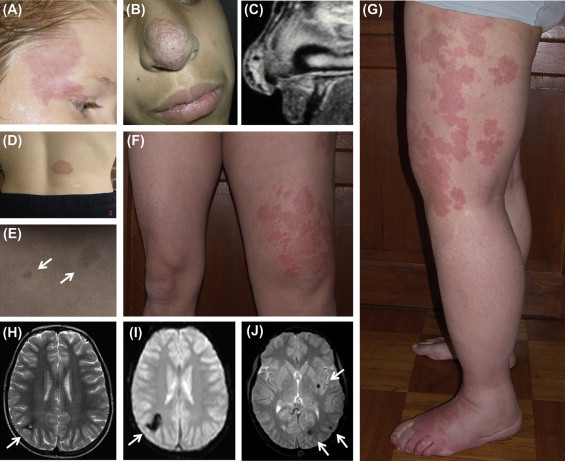 Exploring Congenital Vascular Malformations